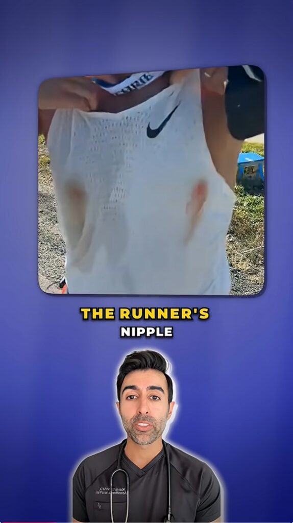 Video explaining runner's nipple.