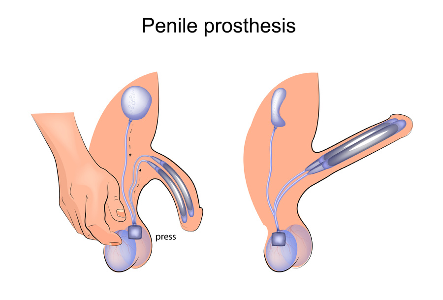 Penile prosthesis diagram.