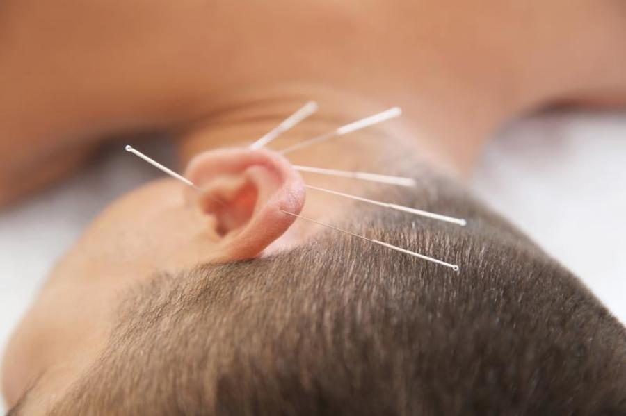 Acupuncture