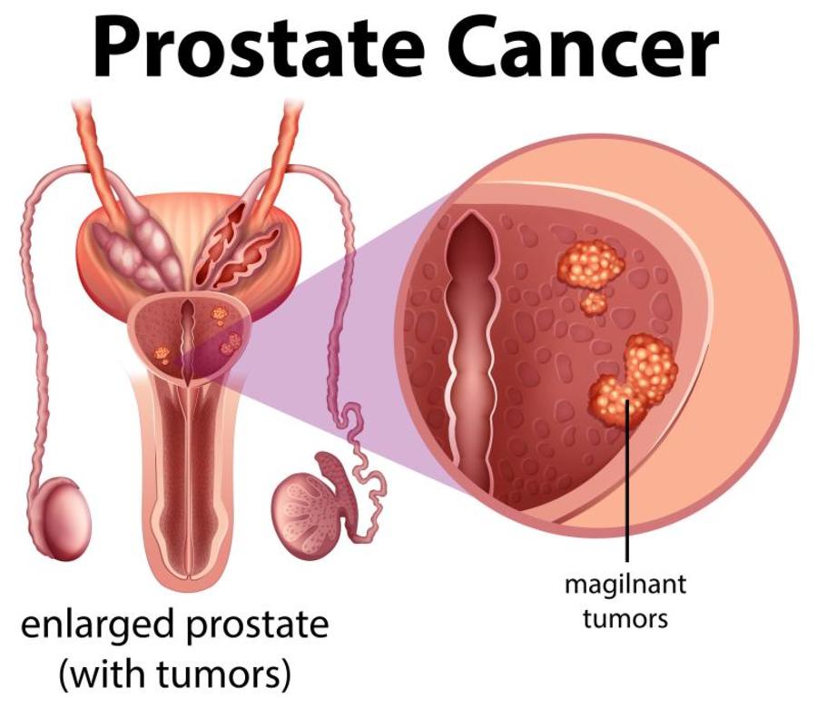 Prostate cancer illustration.