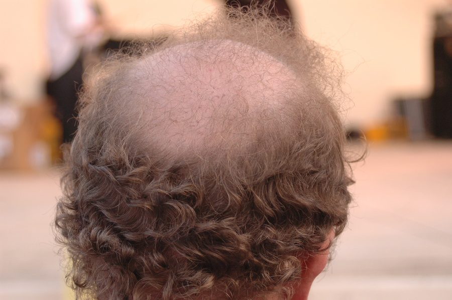 Man with balding.