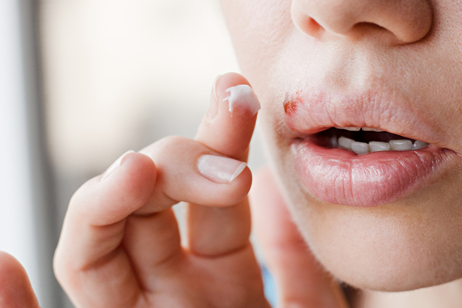 Cold sore on a top lip.