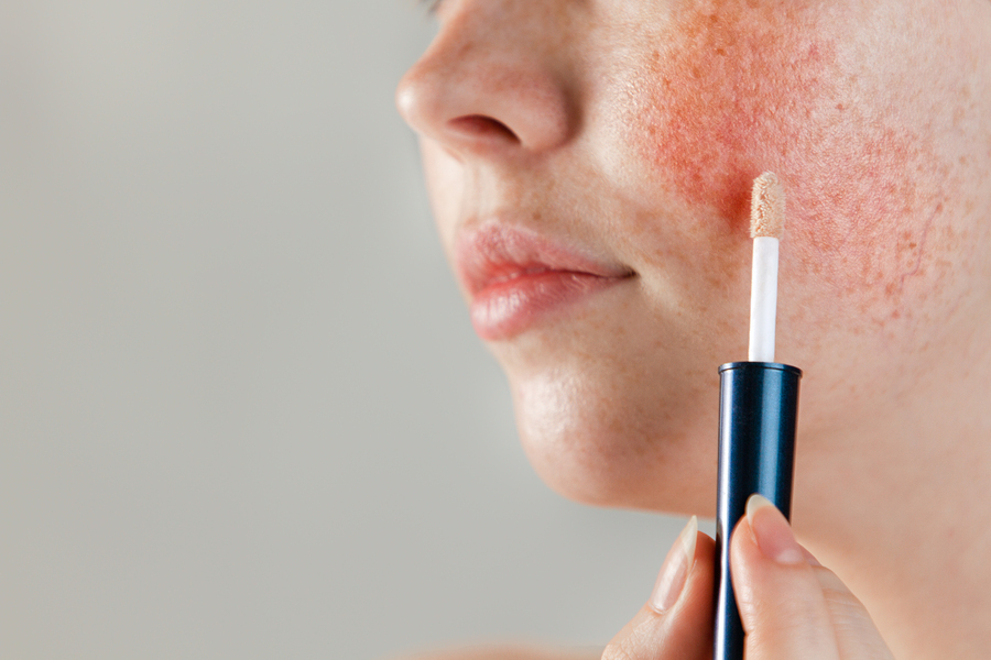Woman covering up rosacea on her cheek with makeup.