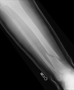 gutter installer injury