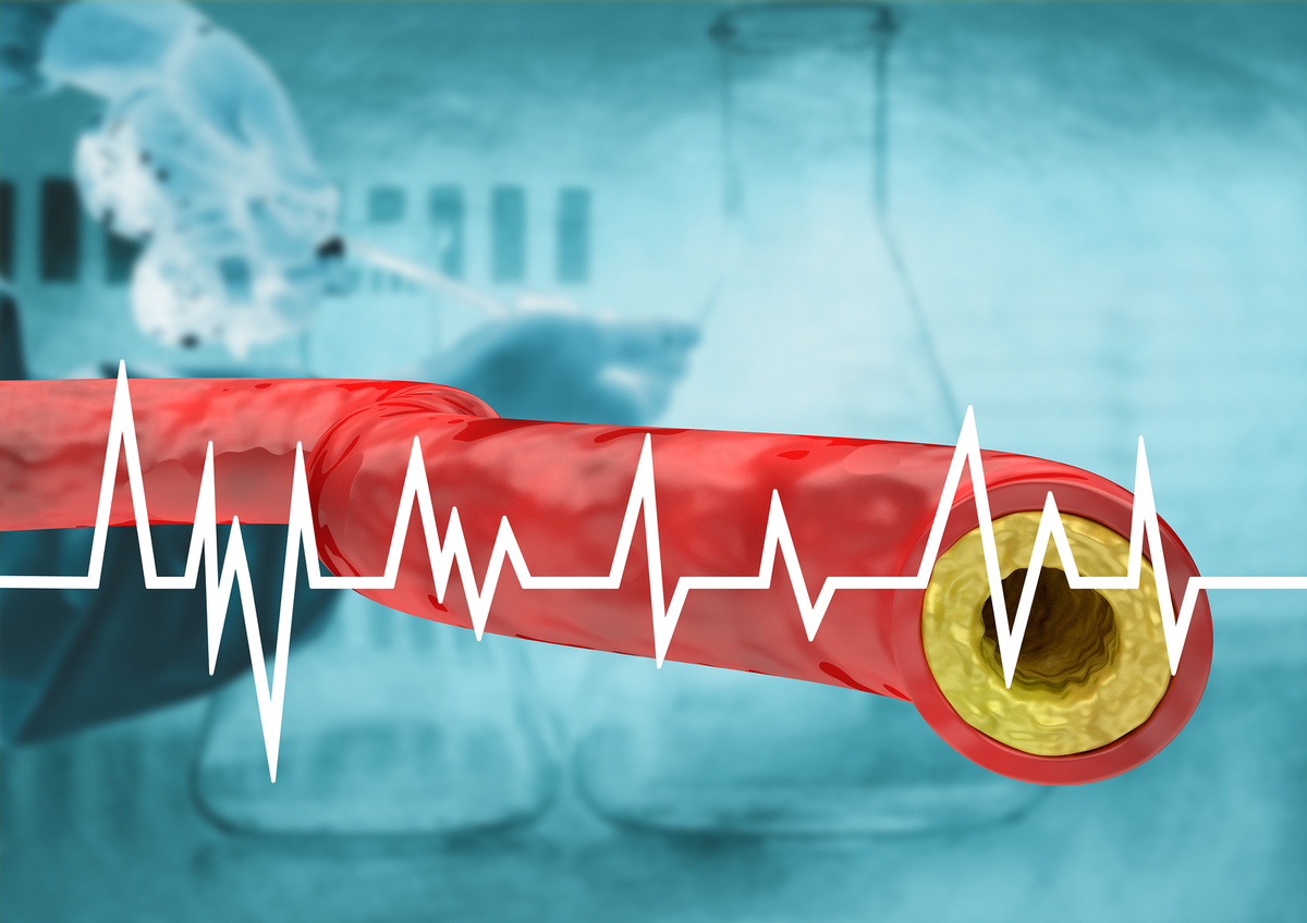 Diagram of an artery.