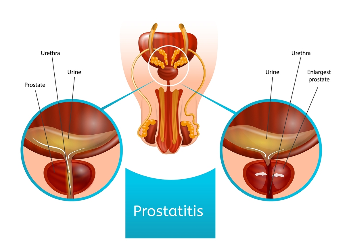 Diagram of a prostate with prostatitis.